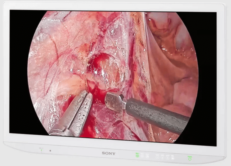 Mini Led Surgical Display Dual Sony 27" 4K, LMD27M1MD/A, Los colores mas esquisitos en cirugia